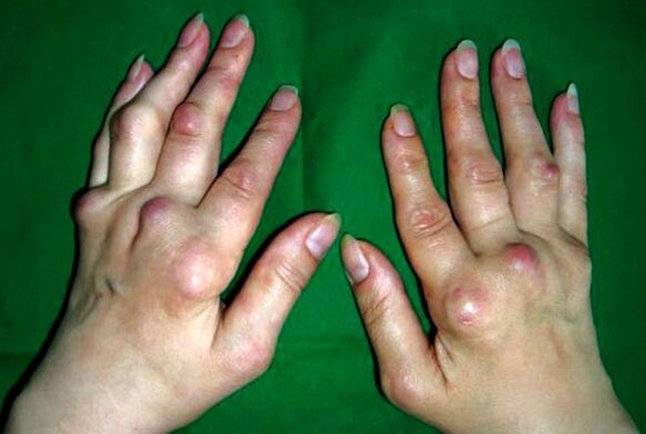 Кисти рук, пораженные деформирующим полиостеоартрозом